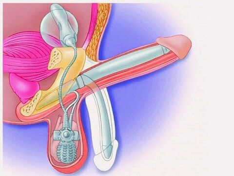 Enlargement of the penis by penile prosthesis