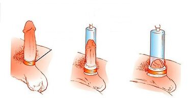 The principle of pump operation to increase the penis