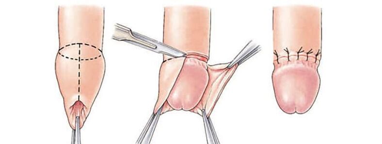 The effect of circumcision in penis size